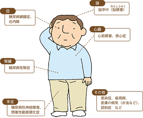 図解：糖尿病が引き起こす全身の合併症