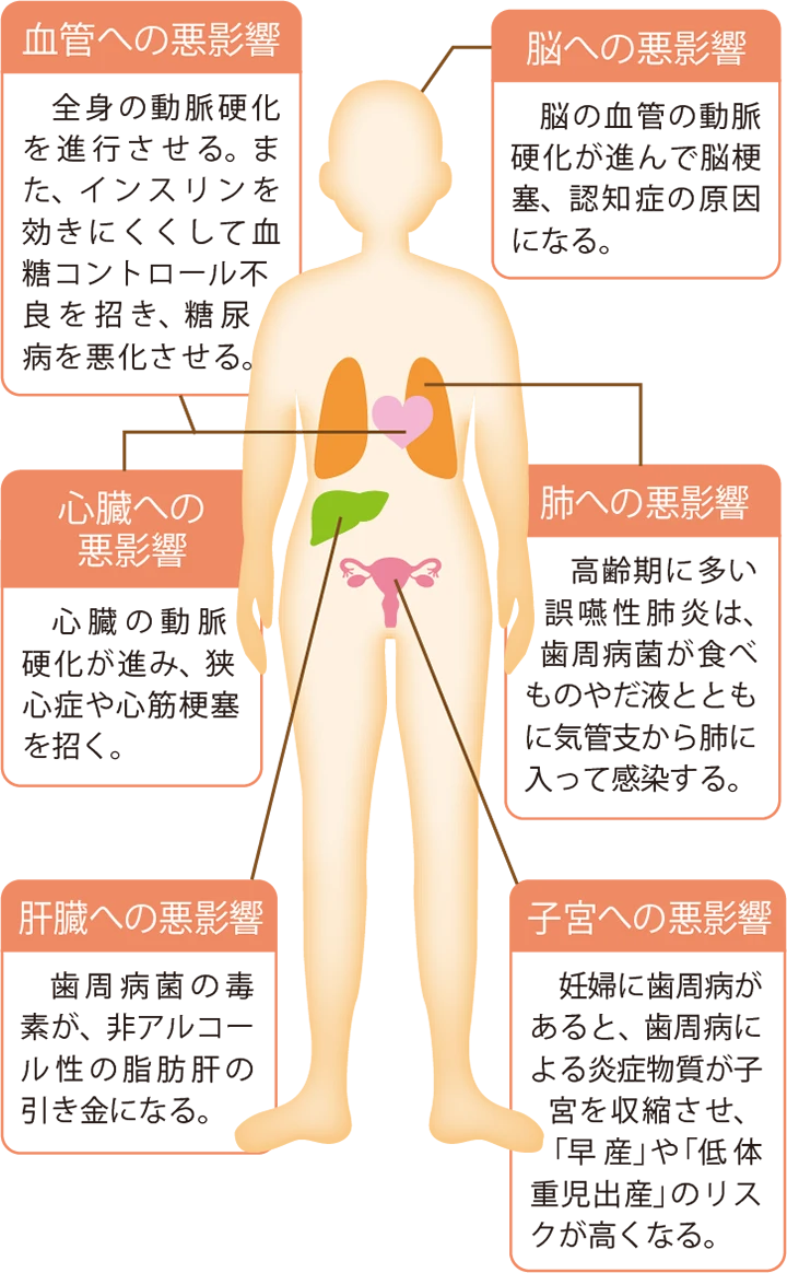 図解：歯周病が及ぼす悪影響